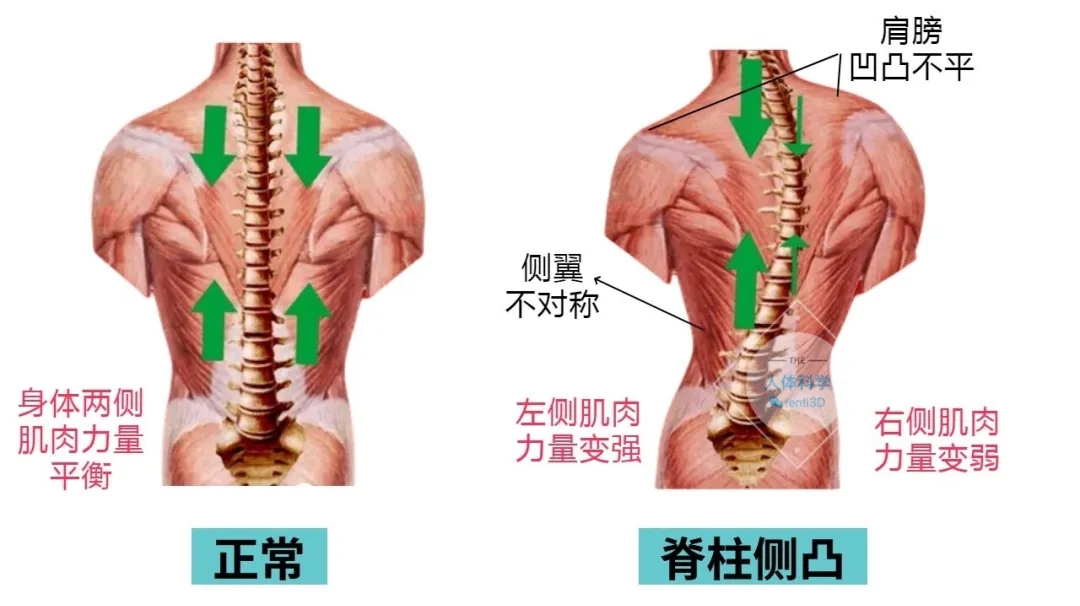 3D打印脊柱側(cè)彎矯形器：從“被動矯正”到“精準醫(yī)療”的跨越式革新  